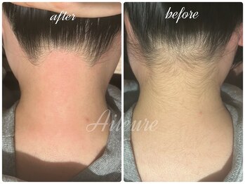 エルール トータルビューティ(Aileure total beauty)/うなじ美人　うなじ脱毛