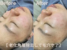 グレース 吉祥寺(grace)/毛穴引き締め角層除去