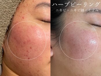 クレスト(CLEST.)/ハーブピーリング