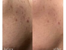 エヌエースキン 北谷店(NAskin)/ハーブピーリング｜ニキビケア