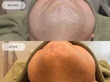 メンズプラス(MEN’S PLUS)/ヒゲ脱毛/ビフォーアフター写真