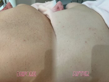 クイーン 渋谷店(QUEEN)/肩回りの産毛