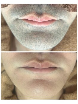 アカラ 読谷店(AKALA)/ヒゲ脱毛6か月経過