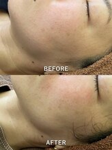 リラクゼーションサロン ラキ(laki)/ネオピール1回