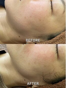 リラクゼーションサロン ラキ(laki)/ネオピール1回