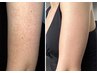 【二の腕ハーブピーリング】ぶつぶつ改善・赤み・ざらつきケア（美肌ケア付）