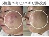 【継続相談】肌質根本改善★フォト+ハイドラ洗浄+VC導入+パック￥22200→6600