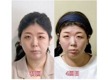 小顔22 ボルティ 本店(Bolty)/30代・施術４回目