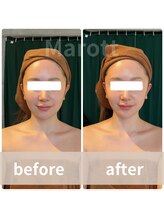 マロット 表参道店(Marott)/【30代女性】瞬間小顔たるみ改善