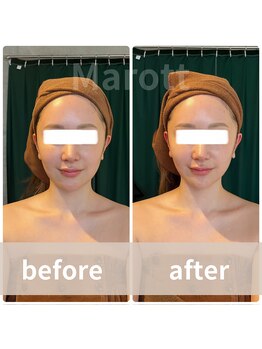 マロット 表参道店(Marott)/【30代女性】瞬間小顔たるみ改善