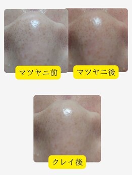 アメイジングボディーワクス(Amazing Body Works)/鼻の黒ずみ