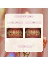 プラスビーセルフ(+b self)/ホワイトニングビフォーアフター