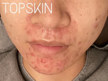 トップスキン 名駅(TOPSKIN)/繰り返す口周りニキビにも◎