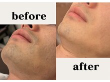 THR方式でしっかり脱毛!!痛みを感じにくい～最新機器～