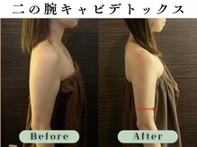 スイスパ(翠SUI SPA)/【二の腕引き締め】Before/After