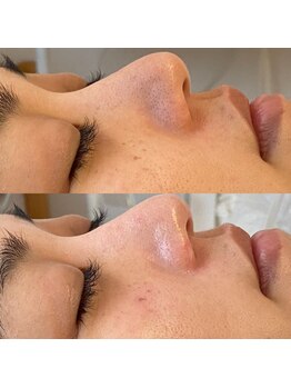 彌庵/次世代毛穴洗浄（鼻）　症例