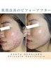 【先着残り10名様限定】約50%OFF/      肌育美容法スキングローピール￥4,950-