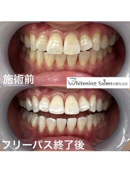 ホワイトニングサロン 京都烏丸店/ホワイトニング施術例