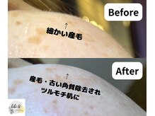 ビビユー(bibi u)/フェイシャル脱毛ビフォ-アフタ-