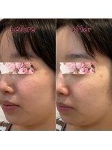 ピエール ナリタイラボ(Piel NARITAI LABO)/小顔整体