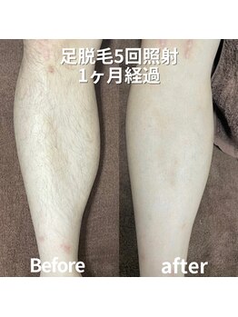 ココ(Coco)/メンズ脱毛・足脱毛・全身脱毛