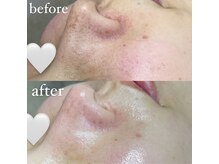 ダブル(W)/毛穴エクストラクション