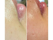 ナチュウル(Natulu)/シルク糸脱毛＊女性の口周りの髭