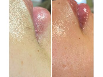 ナチュウル(Natulu)/シルク糸脱毛＊女性の口周りの髭