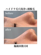 サラ/ハイドラ毛穴洗浄×顔脱毛