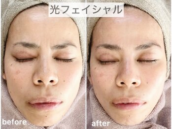 ブルーム(Bloom.)/光フェイシャル