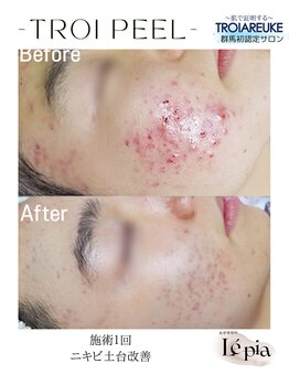 レピア(Le'pia)/トロイアルケ|トロイピール