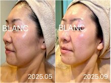 サロン ド ブラン アオヤマ(Salon de BLANC AOYAMA)/BLANC式小顔60分