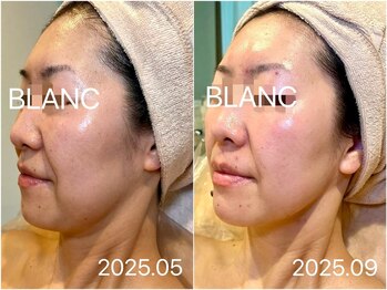 サロン ド ブラン アオヤマ(Salon de BLANC AOYAMA)/BLANC式小顔60分