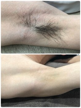 アルシスタ(ARCISTA)/【メンズ脱毛】