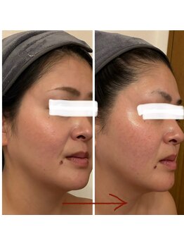 ユフラ(Juhla)/切らない小顔リフト