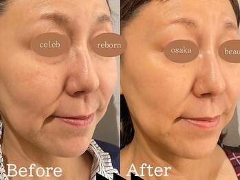 セレブリボーン 大阪ボーテ/ヒト幹細胞/エイジングケア