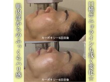 ハニエル(Haniel)/カーボキシー症例