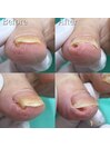 【巻き爪/陥入爪】