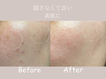 シミケア×大人の肌質改善sol.高槻【光フェイシャル/たるみ/毛穴/シワ/美白】の写真/昔より肌が暗く見える、透明感がなくなった…。シミ・くすみ・色ムラをケアして、透明感のある素肌へ。