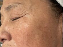 オアシスラグーン(OASIS LAGOON)/シミケア（症例７：after）