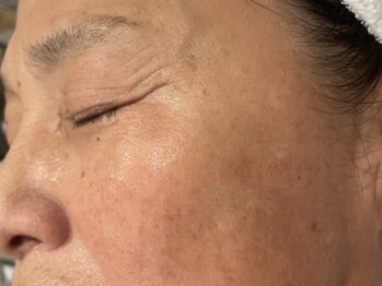 オアシスラグーン(OASIS LAGOON)/シミケア(症例7:after)