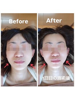 美藤鍼灸院/美容鍼のBefore After