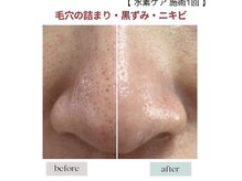 ジェニックサロン グランドギンザ ひたちなか(GENIC SALON GRAND GINZA)/目指せ毛穴レス！