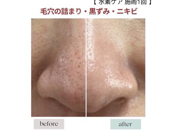 ジェニックサロン グランドギンザ ひたちなか(GENIC SALON GRAND GINZA)/目指せ毛穴レス!