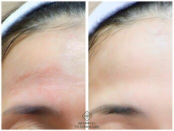 アンレミューラボ(Un Lemieux Labo)/赤み、かぶれ改善