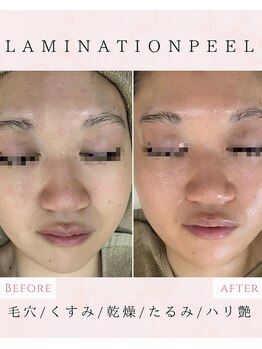 ルリエベル(Relier Belle)/ラミネーションピール1回