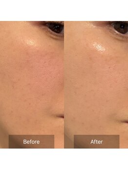 オルネ(ORNE.)/《セラピール》