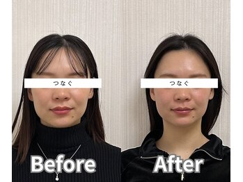 つなぐ/美容鍼☆ 4回の施術の変化