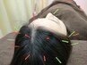 【頭スッキリ鍼】 頭皮鍼+ほぐし 美髪 育毛 快眠 45分 4500円→3900円