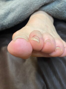 巻き爪矯正before